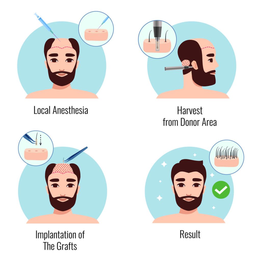 hair transplantation